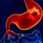 7-semne-ca-ati-putea-avea-ulcer-la-stomac.jpg